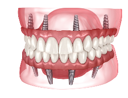 Permanent Zirconia Teeth Double Arch