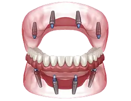Permanent PMMA Teeth Single Arch